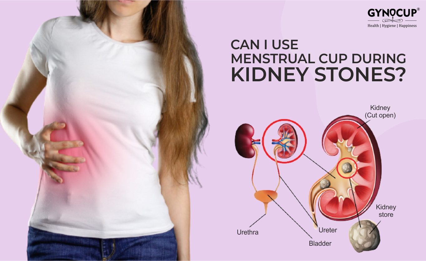Can I Use Menstrual Cup During Kidney Stones?